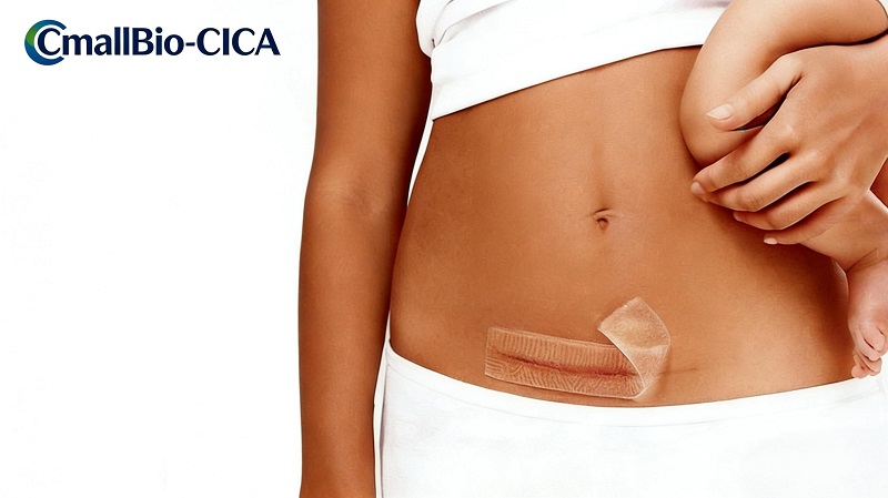 CmallBio Thickened Silikon Scar Patch (CmallBio-CICA) presterer strålende nylig, stabiliserer sin posisjon i toppsjiktet for medisinsk silikon arrfjerning