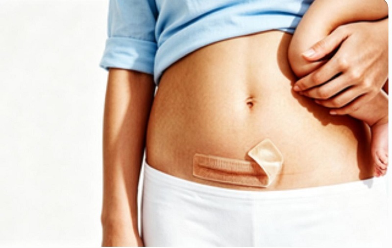 Trygg hormonfri CmallBio silikon arrplaster for arrpleie ved keisersnitt